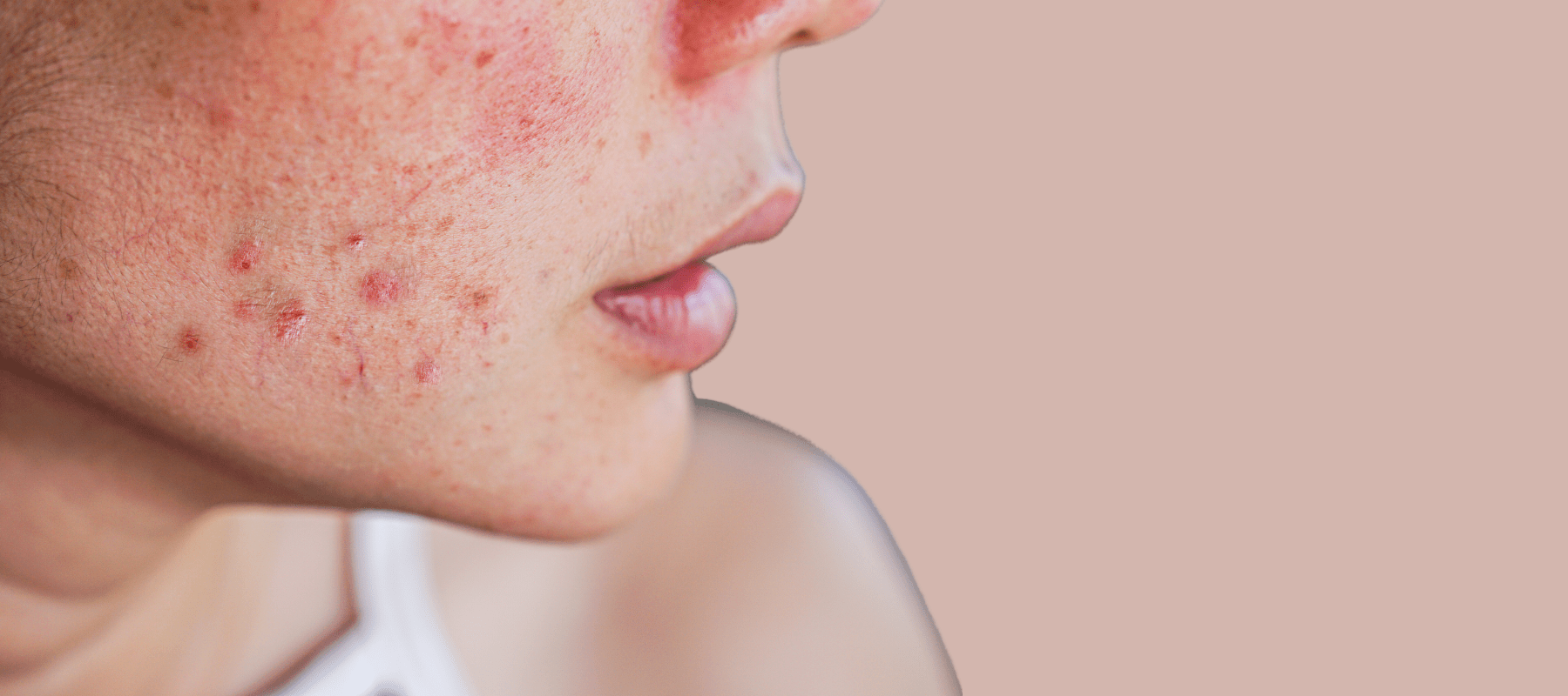 Know the causes of uneven skin tone