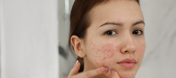 Know the different types of pimples & treatment for it