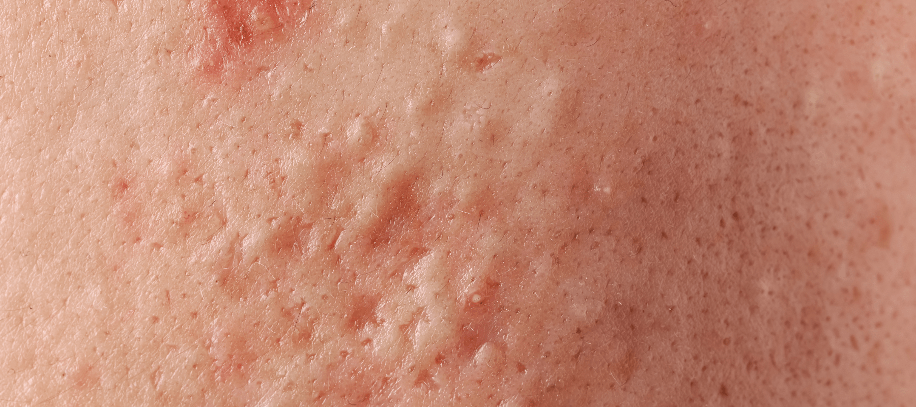 Meaning and causes of comedones on face