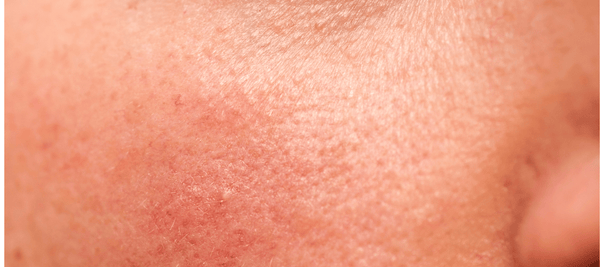 Methods for getting rid of bumps on the face