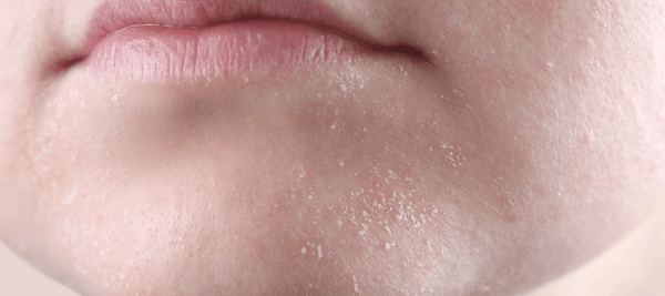 Niacinamide Benefits for Dry Skin: Hydration and More