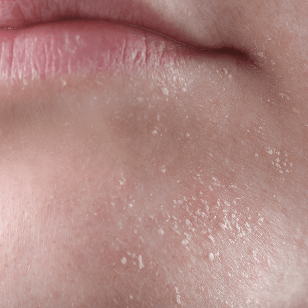 Niacinamide for store dry skin