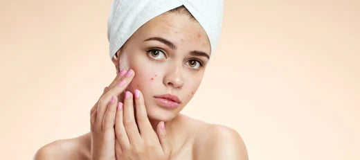 Period pimples