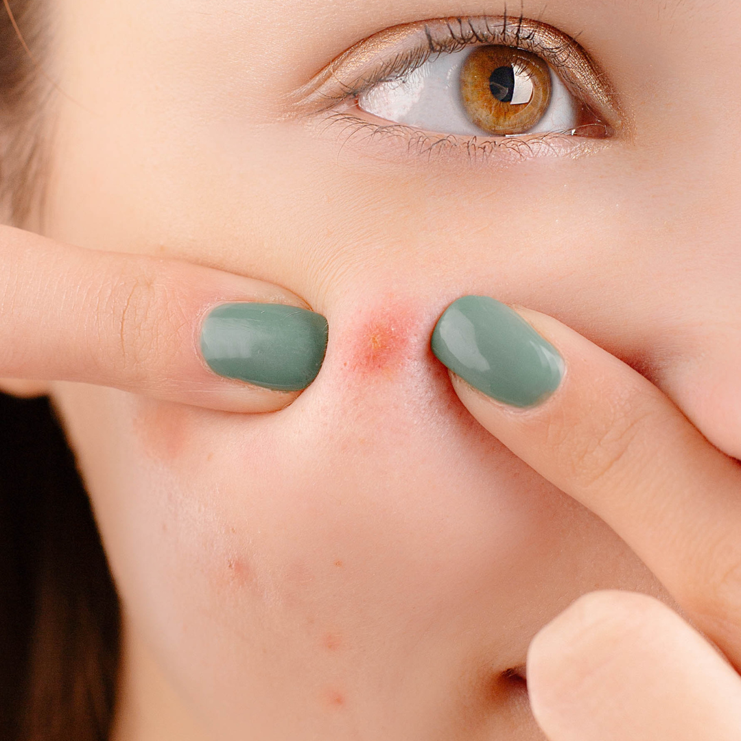 How to apply acne spot corrector and what are its benefits?