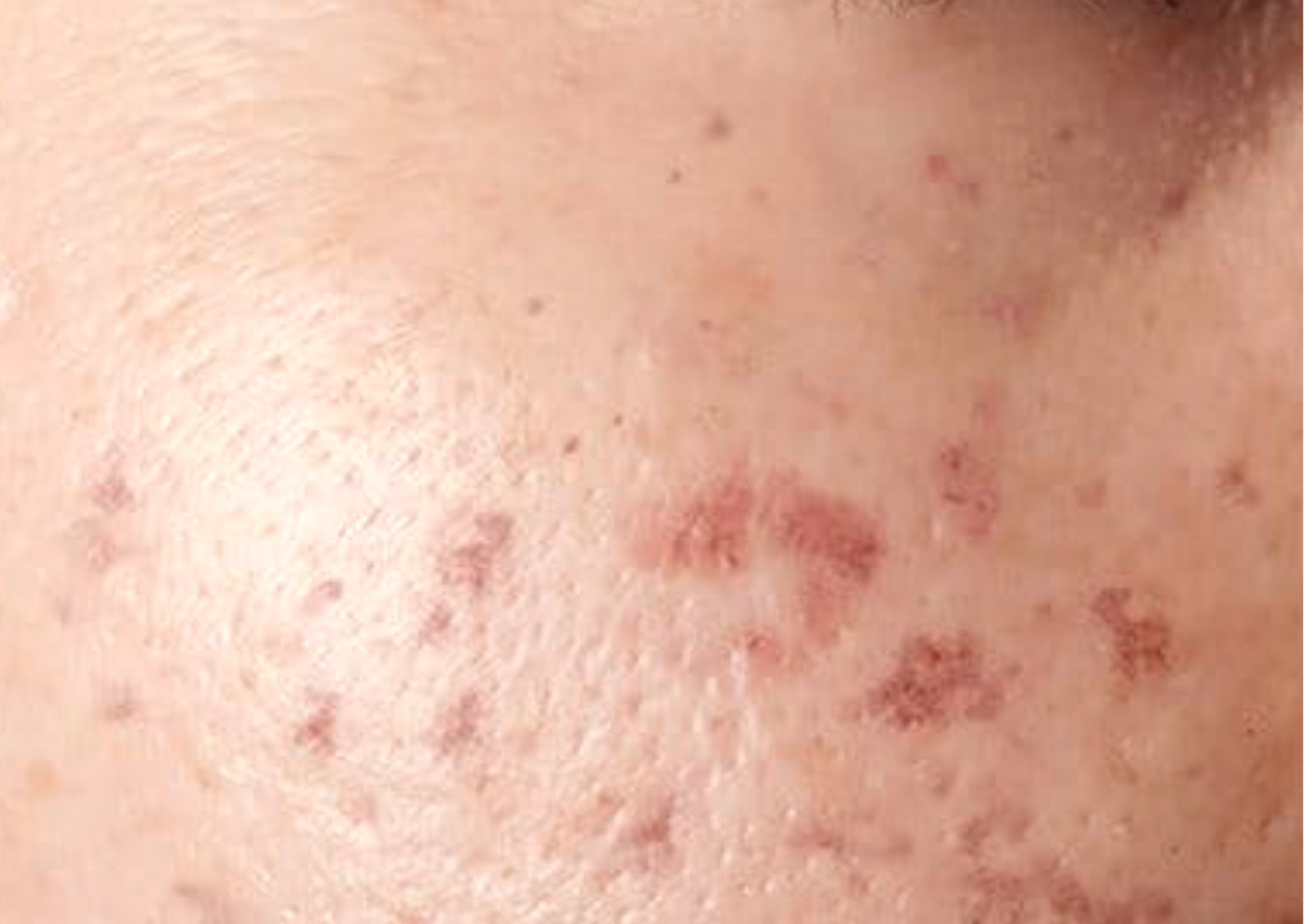Post Infectious Hyperpigmentation Post Inflammatory Hyperpigmentation (PIH) Causes & Treatment - The Pink ...
