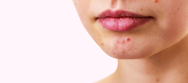 Understanding the causes of Pustule Facial Acne breakouts on your face  