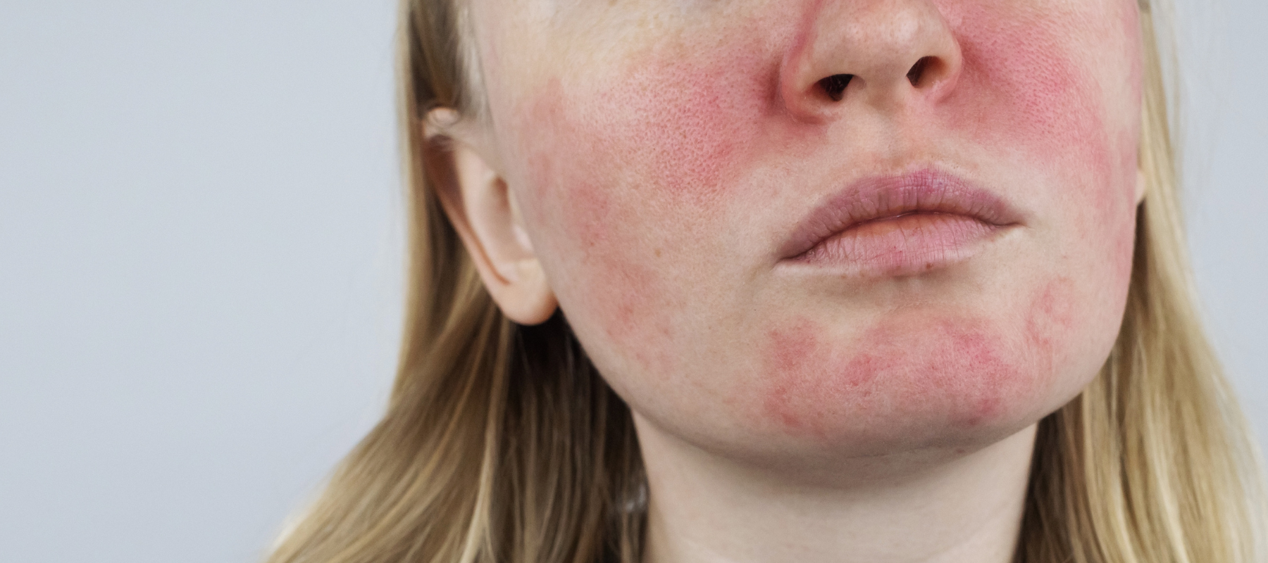  Rosacea Skin