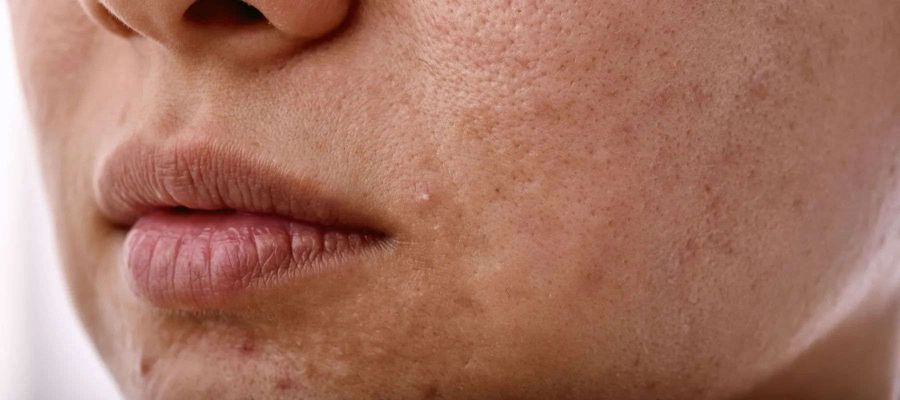 Sallow skin causes and treatment