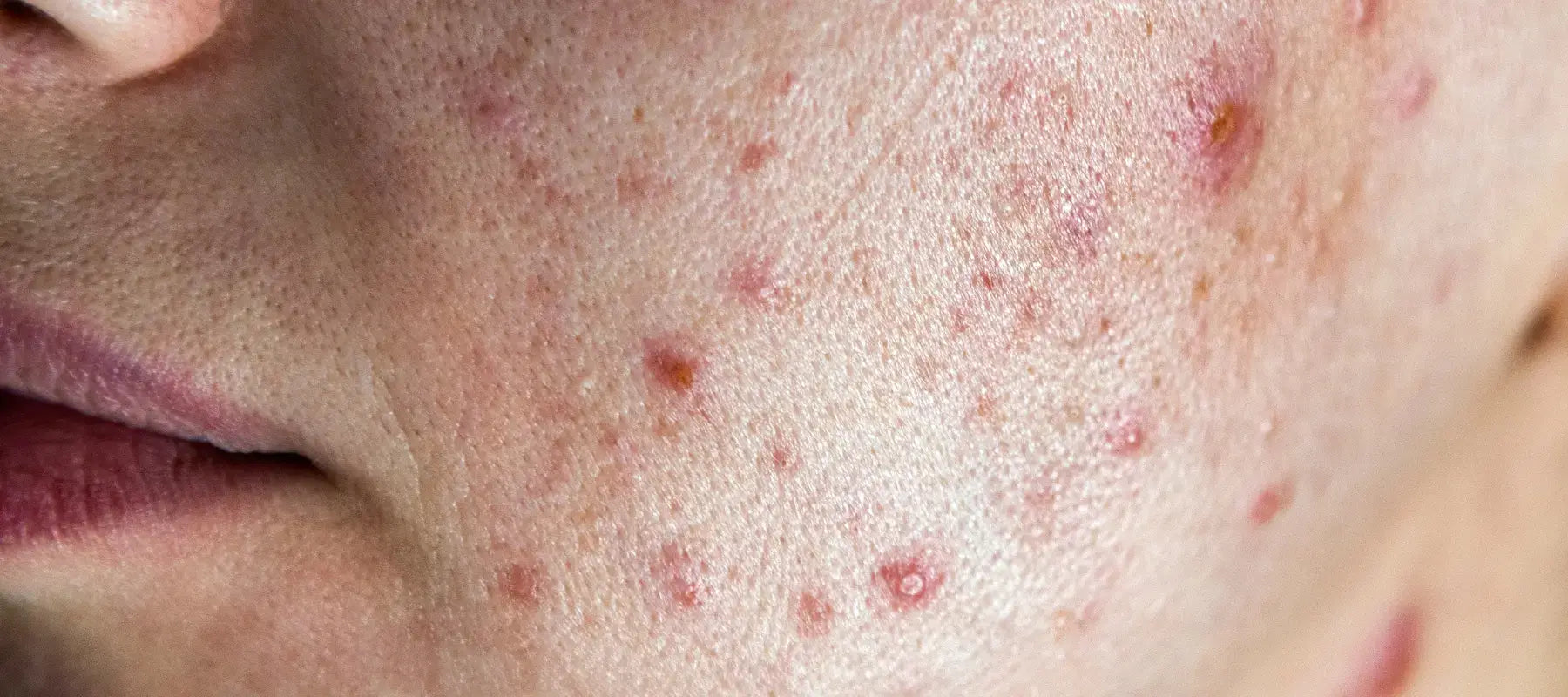 Severe acne on face