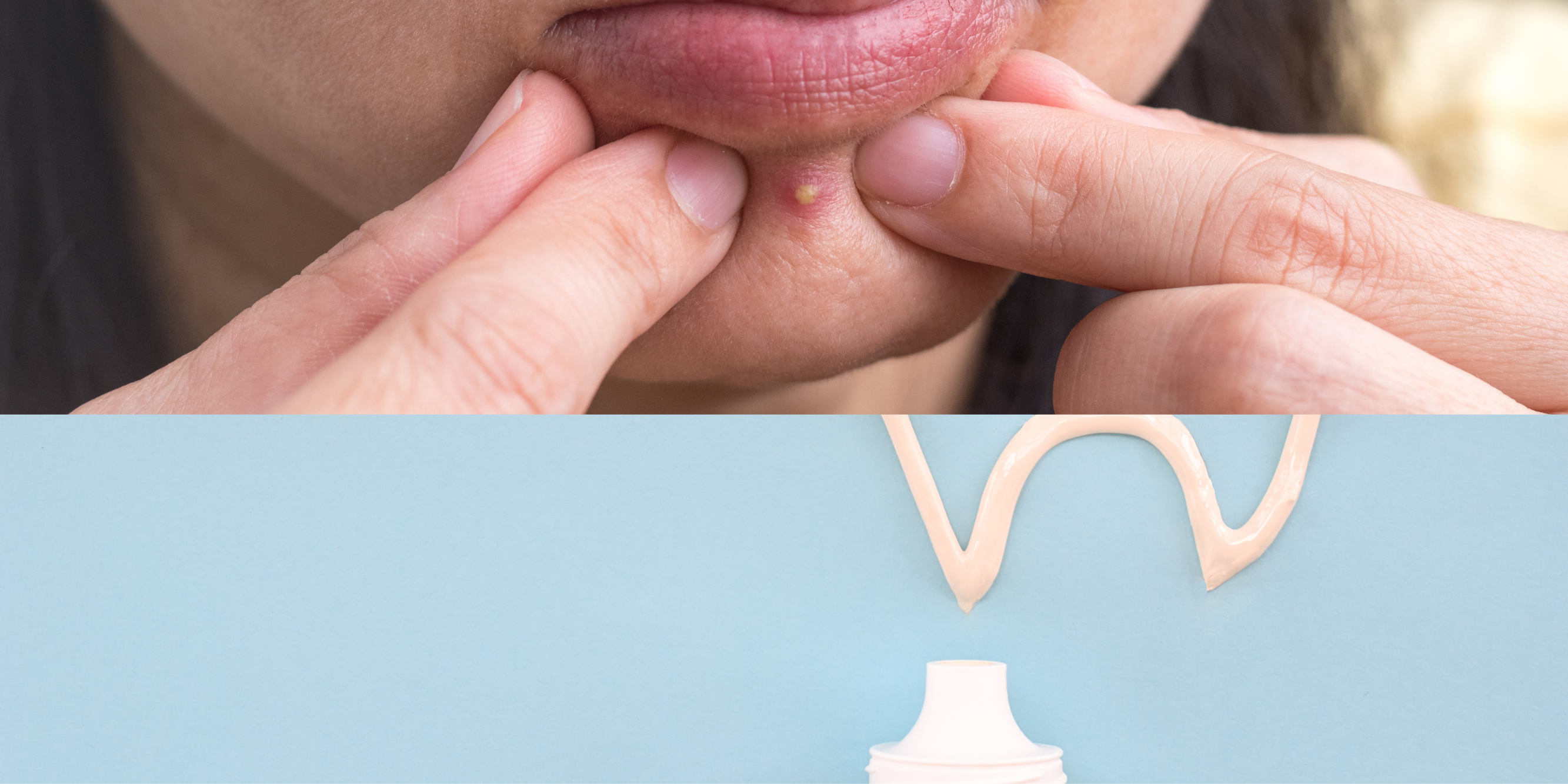 Should we apply toothpaste on pimple?