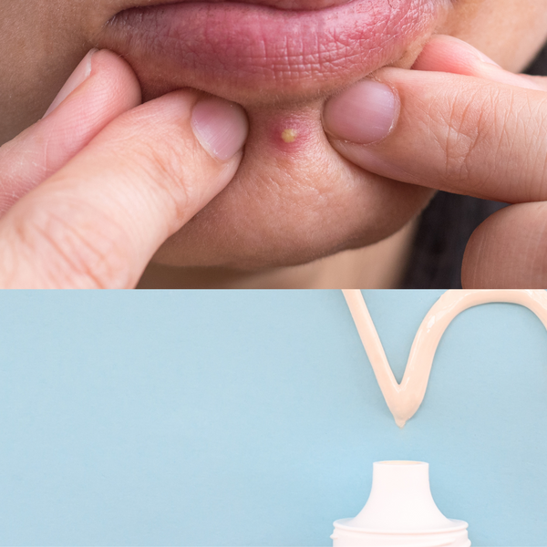 Is Applying Toothpaste on Pimples Safe Read this Before You Try