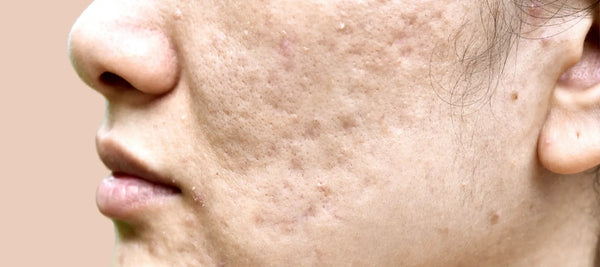 Skin puging vs breakouts on face
