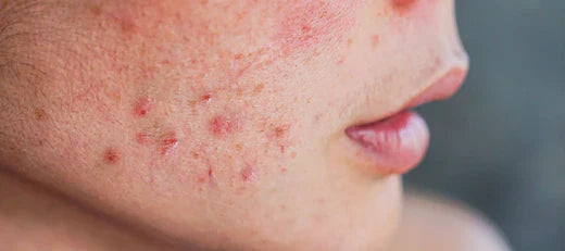 Skin redness on face