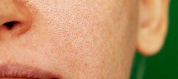 Skincare product to reduce open pores on her face