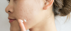 skincare routine for acne-prone skin
