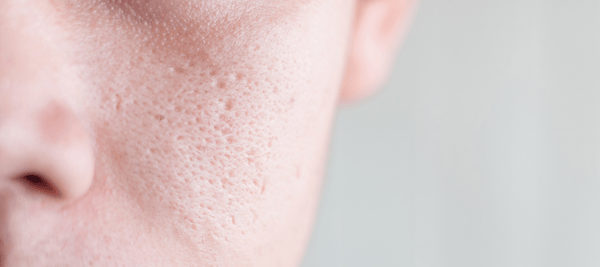 Skincare routine to minimizing Face Pores