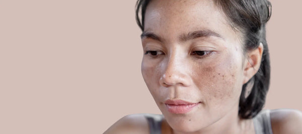 Sun damaged skin on face identification and treatment