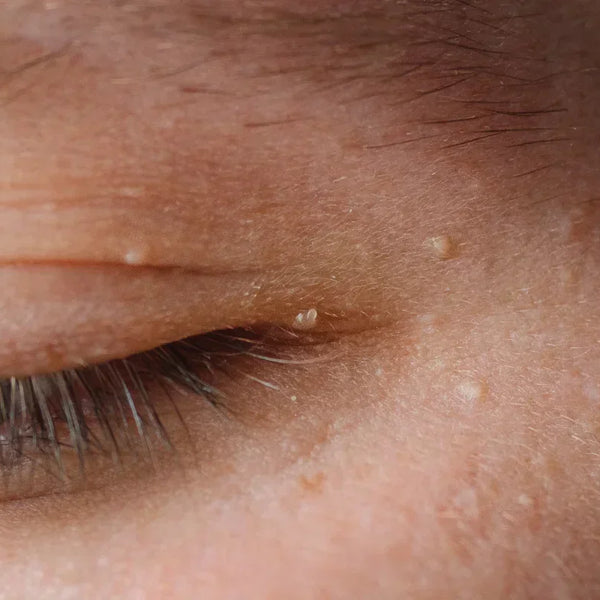Pimple On Eyelid Causes And Treatments For Eyelid Pimples The