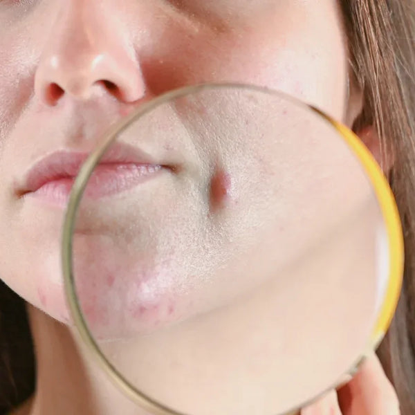 Big Pimples Meaning Causes Treatment For Big Red Pimples On