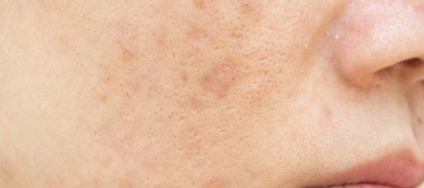 Black spots after pimples on face