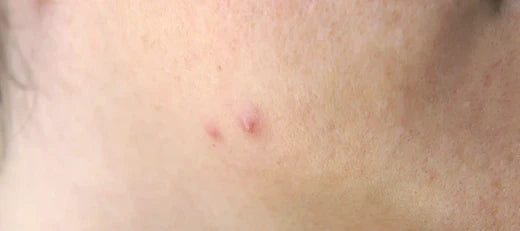 Heat Pimples on Face