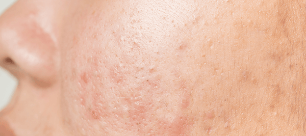 The causes and treatment of atrophic acne scars