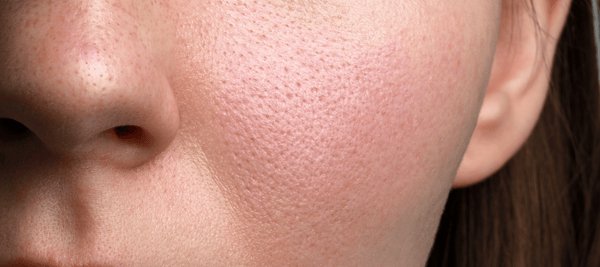 The causes, types, and solutions for textured skin