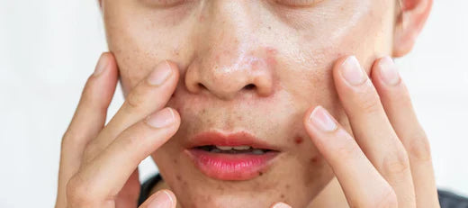 Oily nose treatments