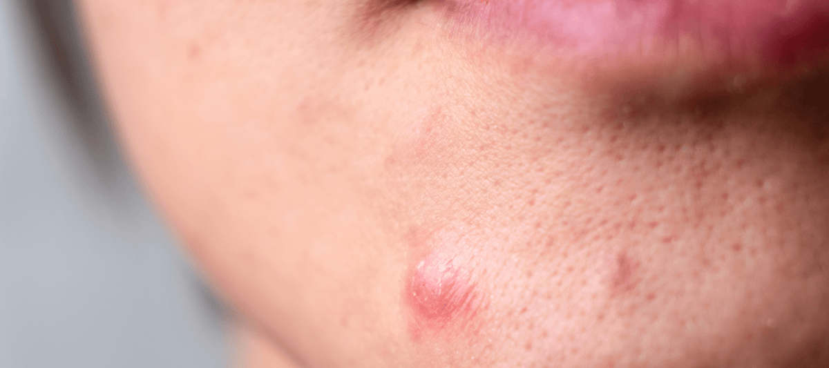 China Pimples Exploding Pimples on Chin - Indicates, Reasons, How to Get Rid of Pimples on Chin ...