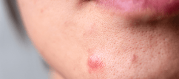 Tips on how to get rid of pimples on the chin