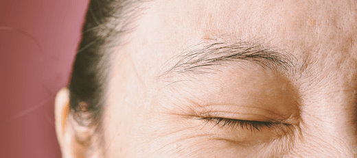Pimple Between Eyebrows, How to Get Rid of Acne Middle of Eyebrows ...