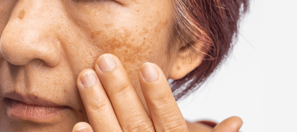 Ultimate guide to pigmentation treatment