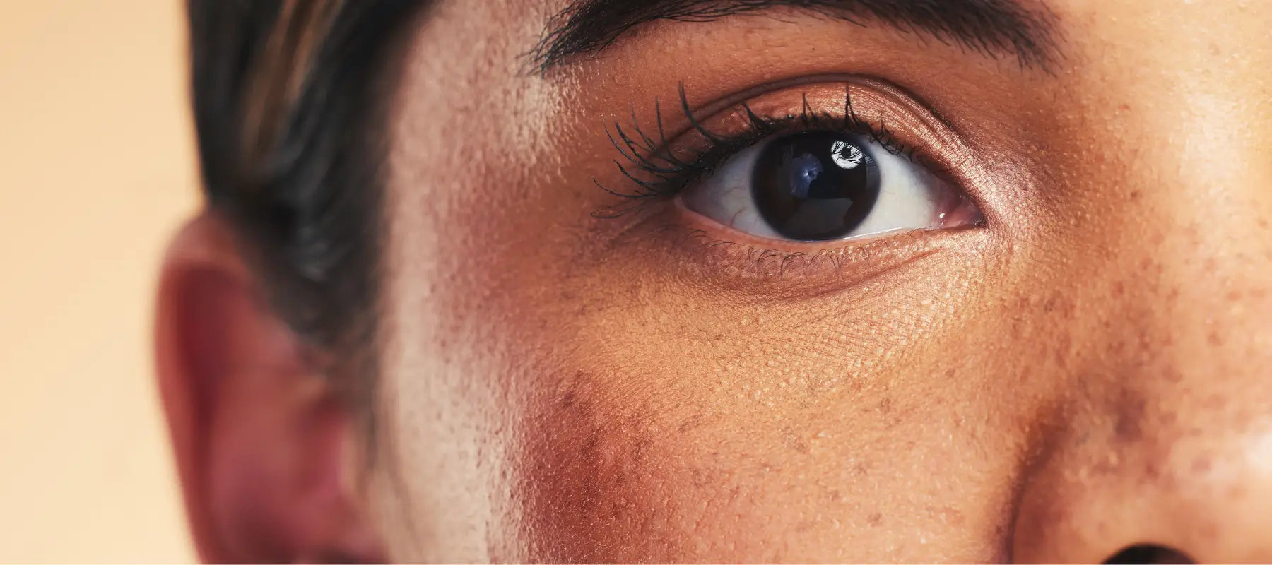 Causes of melasma on face