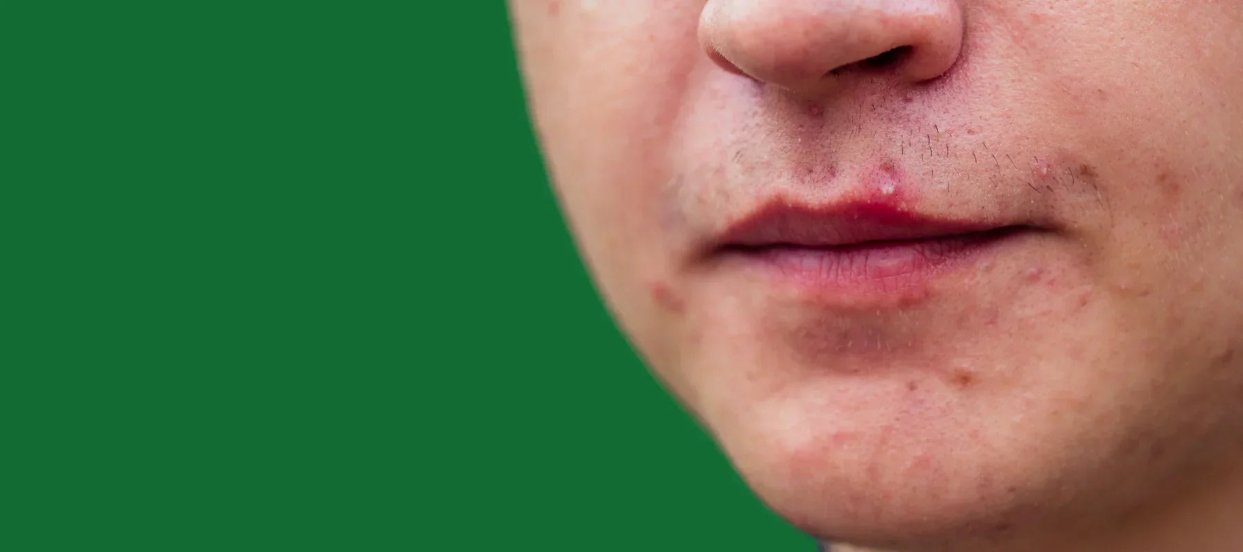 What is cystic acne