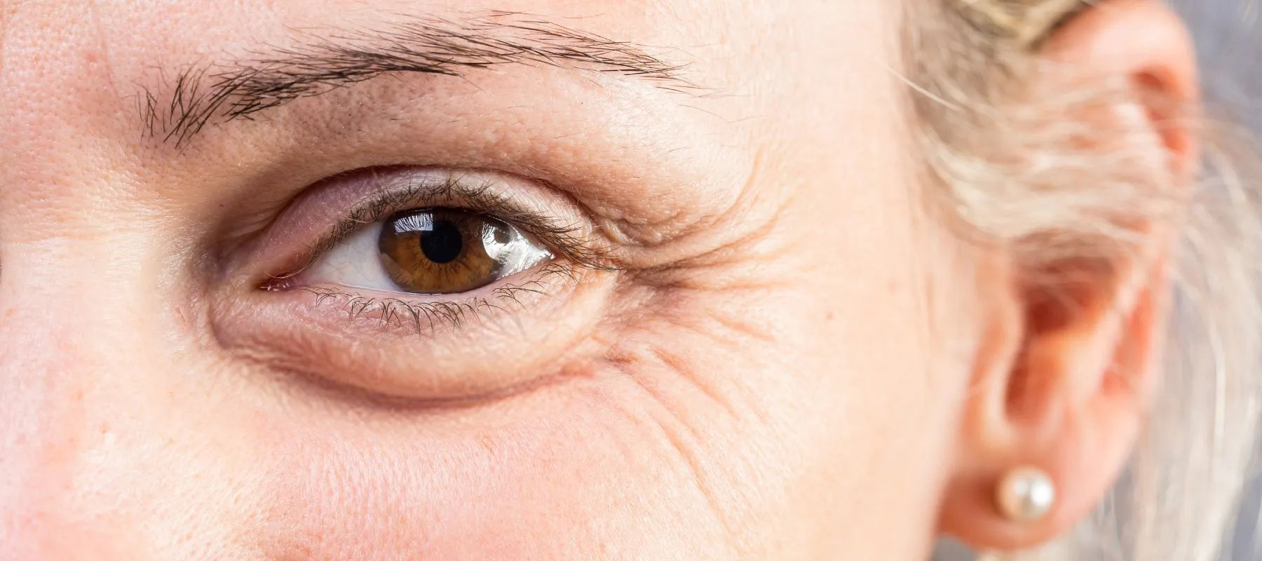 Crows feet