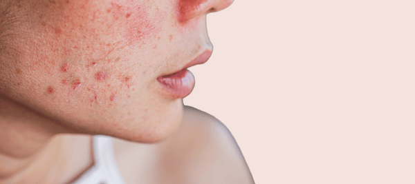The Pink Foundry guide to different forms of Facial Acne on your face