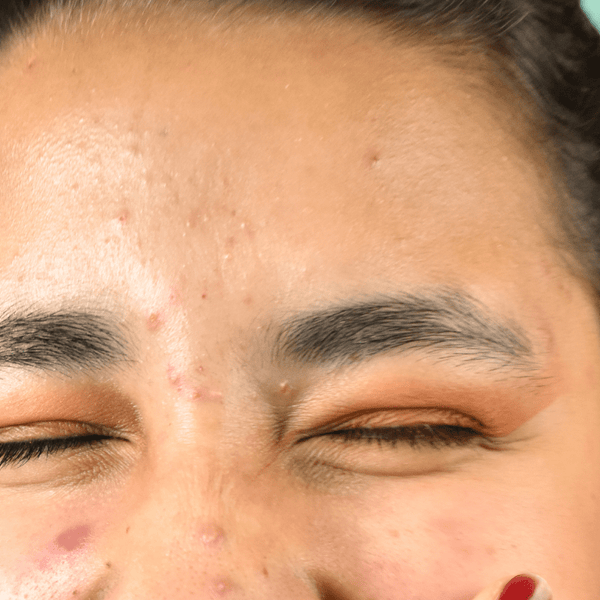 Facial Bumps Causes and Solutions for Bumps on Your Face The