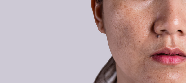 Understanding what causes dark spots on your face