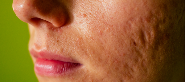 Various types, causes, and treatment options for face blemishes