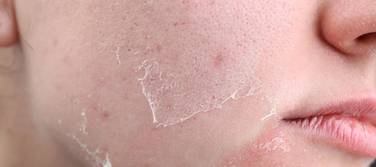 https://www.thepinkfoundry.com/cdn/shop/articles/What_Is_Dead_Skin__How_To_Remove_Dead_Skin_From_The_Face.webp?v=1745832218&width=2048