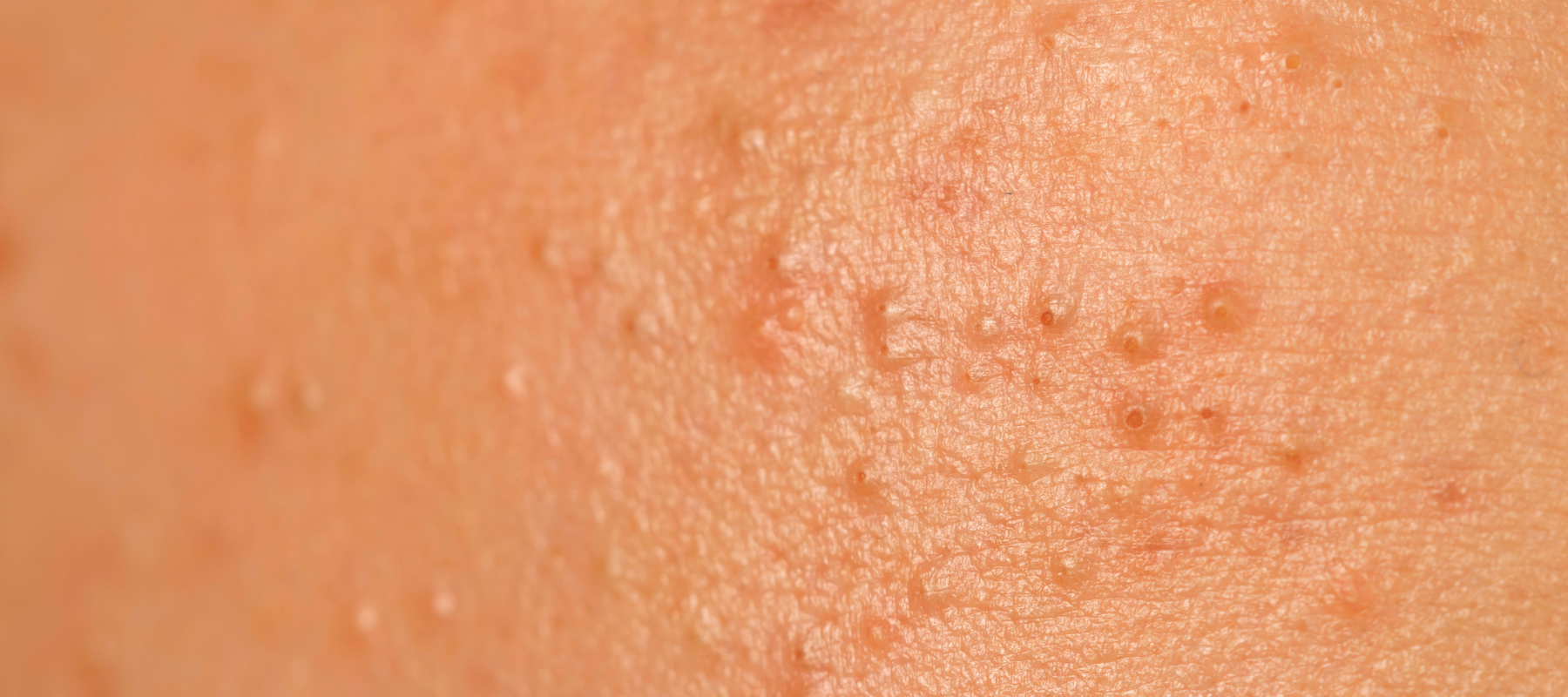 What are different types of small pimples