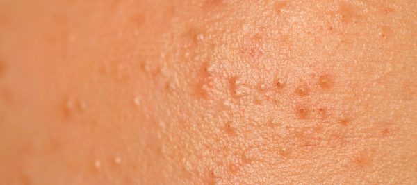 What are different types of small pimples