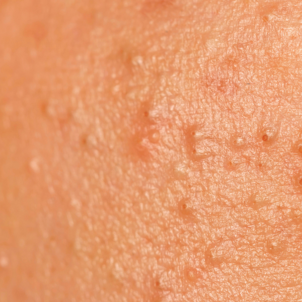 Tiny pimples sale on face