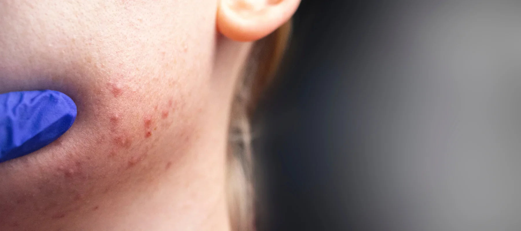How to remove blemishes fast