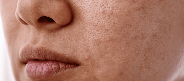What are the different types of acne scars