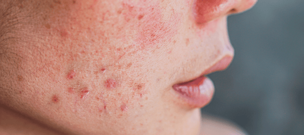 What is Nodules acne and their causes and treatment