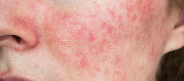 What is acne rosacea