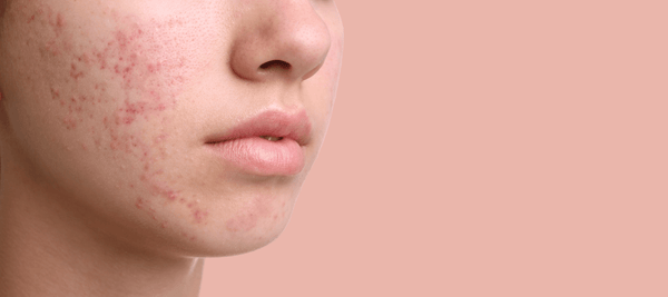What is acne vulgaris