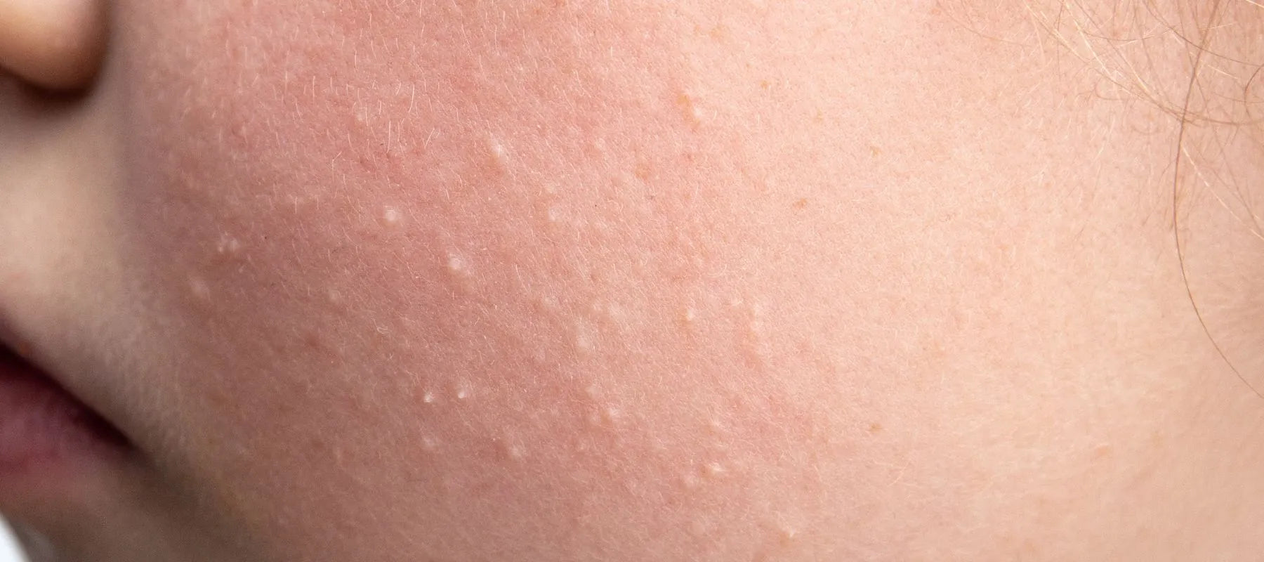 White spots on skin