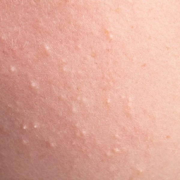White spots on skin cheap